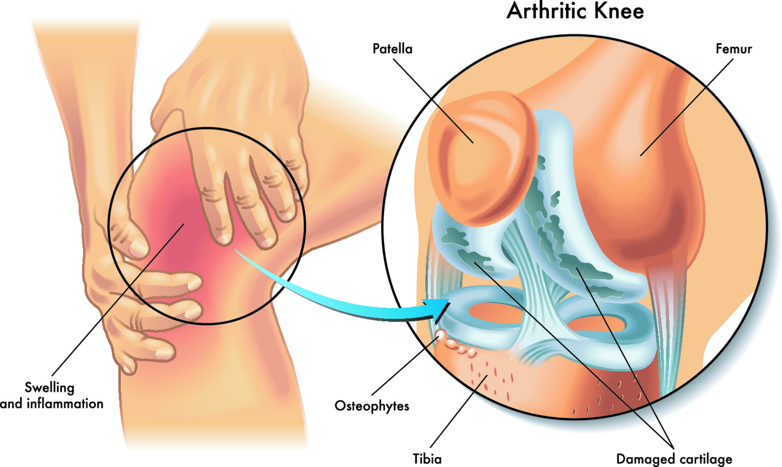 Ko te artroza kolena nauči poslušati svoje telo